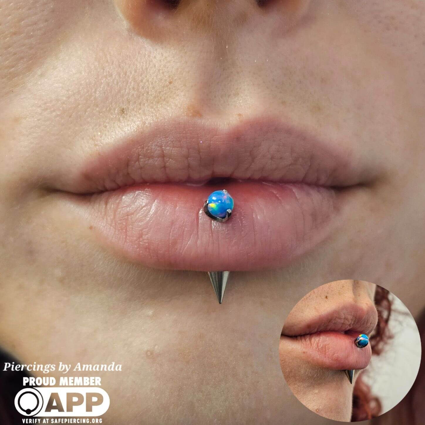 Healed and downsized vertical labret piercing with implant grade titanium